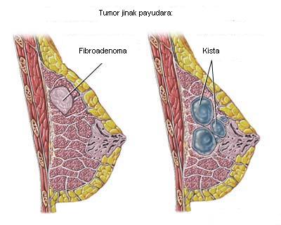Мастопатия Fibroadenoma